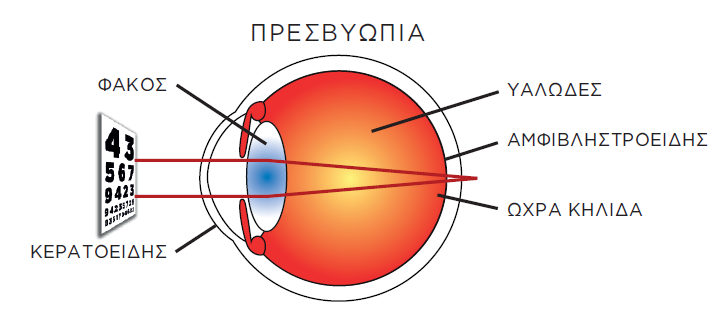 Presvyopia